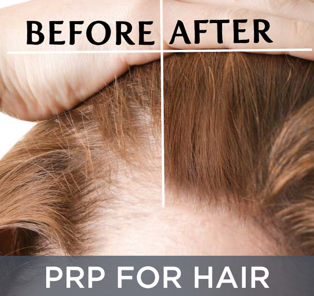 prp for hair regrowth indianapolis